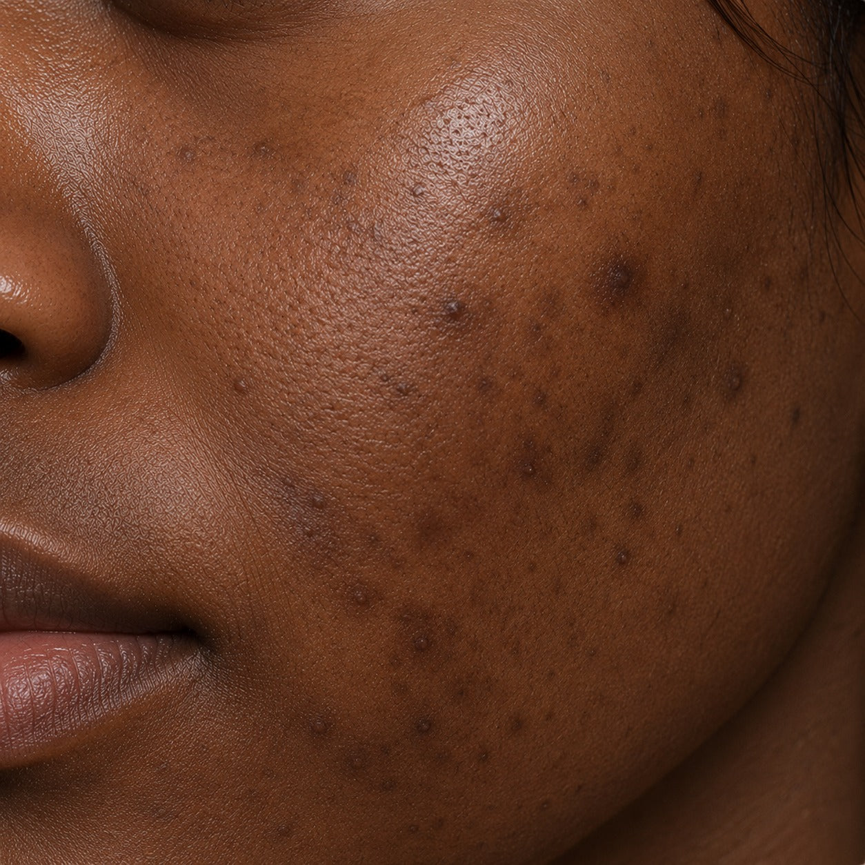 Dark Spots & Pigmentation